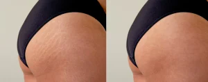 Inkless Stretchmark and Scar Removal